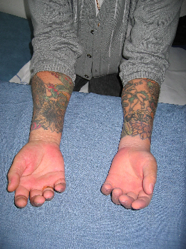 hand Prosthesis