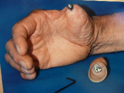 finger Prosthesis