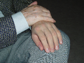 hand Prosthesis