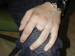 finger Prosthesis