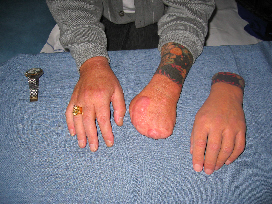hand Prosthesis